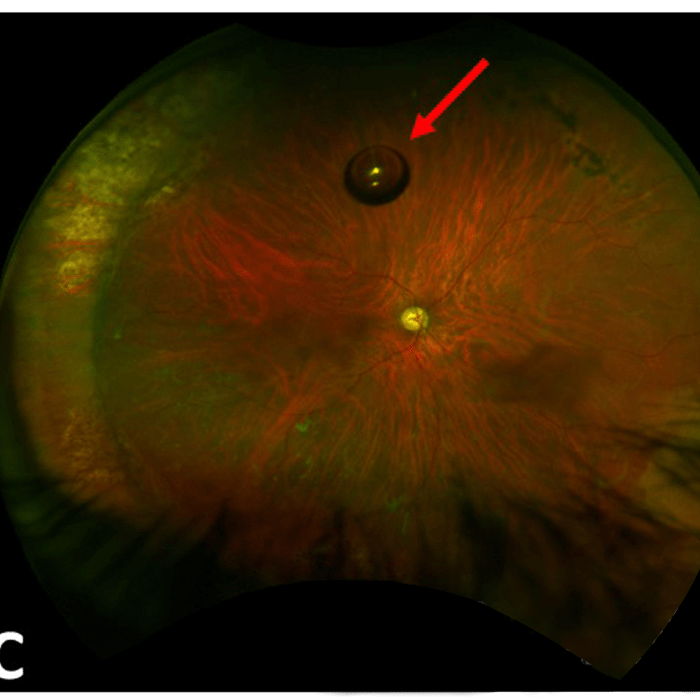 Retina - Hospital de Olhos