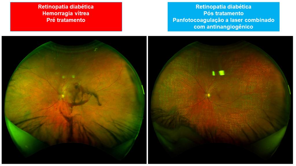 Tratamento da Retina - Instituto de Moléstias Oculares